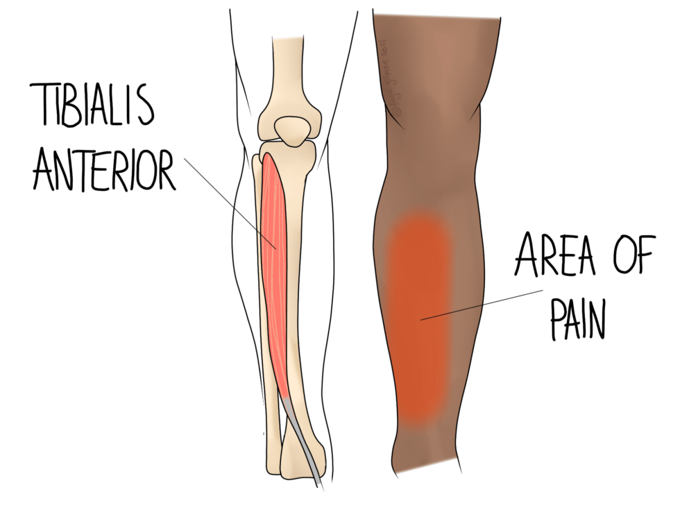 Vị trí cơ tibialis anterior và khu vực đau đặc trưng trong hội chứng shin splints.